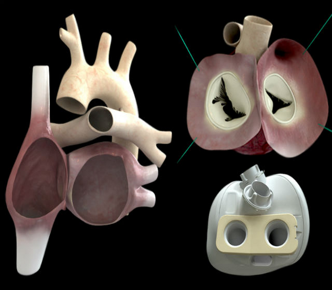 Имплант сердца. Искусственное сердце протез. Искусственные органы человека. Имплантируемые искусственные органы.