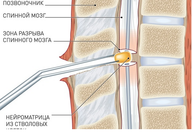 Повреждение спинного мозга. Разрыв позвоночника со спинным мозгом. Перелом позвоночника с разрывом спинного мозга. Стволовые клетки спинного мозга. Полный разрыв спинного мозга.